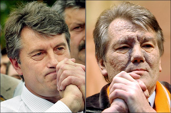 Leader of the Our Ukraine political coalition, Viktor A. Yushchenko, before and after alleged poisoning, July 2004 at left, and November 2004.